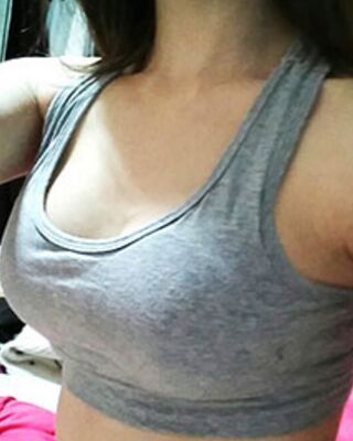 長(zhǎng)沙希美假體隆胸前后對(duì)比果圖，A到C的變化