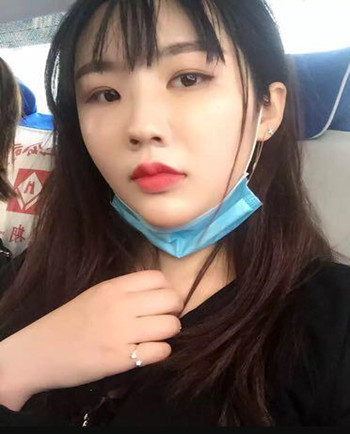 武漢美亞金國(guó)華醫(yī)生幫我做的自體脂肪全臉填充果恢復(fù)案例