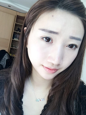 濰坊華美童艷梅醫(yī)生做的面部脂肪填充，大家來看看果怎么樣