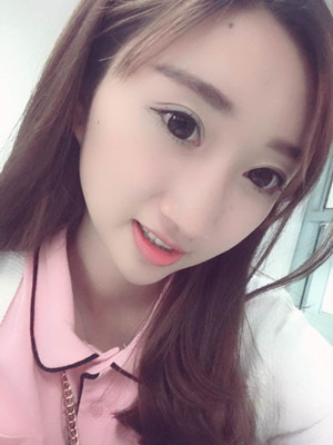 濰坊華美童艷梅醫(yī)生做的面部脂肪填充，大家來看看果怎么樣