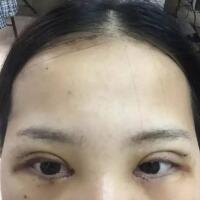 切開雙眼皮+開眼角前后對比圖和恢復過程分享