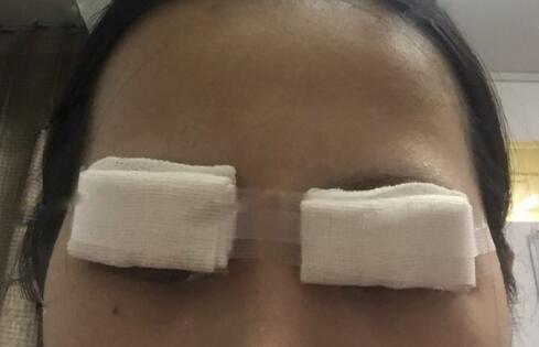 切開雙眼皮+開眼角前后對比圖和恢復(fù)過程分享