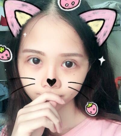 切開雙眼皮+開眼角前后對比圖和恢復(fù)過程分享