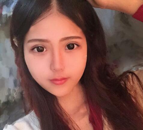 切開雙眼皮+開眼角前后對比圖和恢復(fù)過程分享