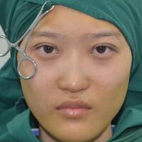 切開雙眼皮多少錢？割雙眼皮真實案例多對比圖分享