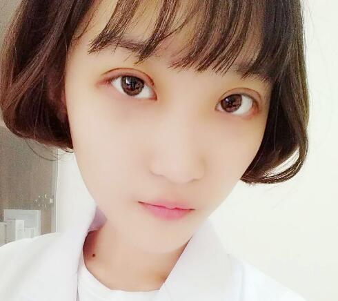 切開雙眼皮多少錢?割雙眼皮真實案例多對比圖分享