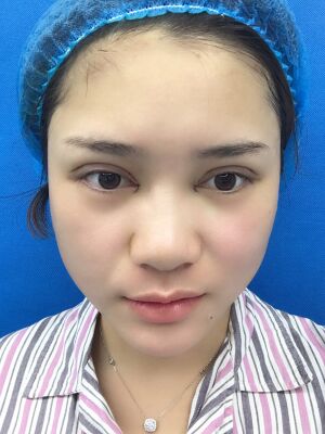 洛陽維多利亞歐式雙眼皮手術(shù)恢復過程圖，真實案例圖