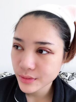 洛陽維多利亞歐式雙眼皮手術(shù)恢復過程圖，真實案例圖