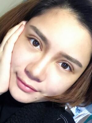 洛陽維多利亞歐式雙眼皮手術(shù)恢復過程圖，真實案例圖