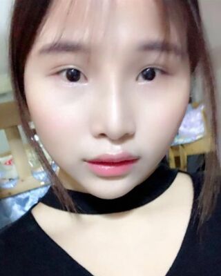 仇侃敏韓式隆鼻整形恢復(fù)果對(duì)比照片