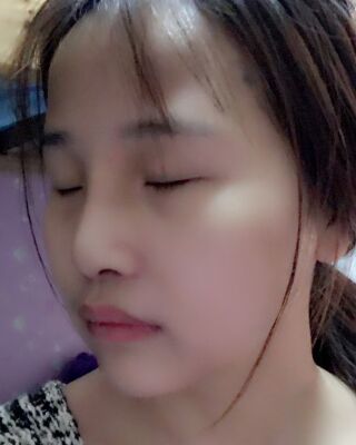 仇侃敏韓式隆鼻整形恢復(fù)果對(duì)比照片