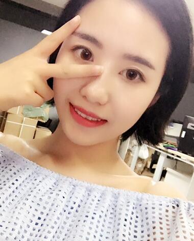 武漢憶美凱德去眼袋手術后兩個月照片