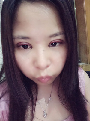 深圳南西子袁新平醫(yī)生做的割雙眼皮+開眼角前后恢復過程圖片分享