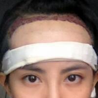 種頭發(fā)有用嗎？種植頭發(fā)恢復過程真實案例——南京明基醫(yī)院