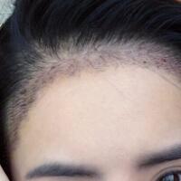 種頭發(fā)有用嗎？種植頭發(fā)恢復過程真實案例——南京明基醫(yī)院