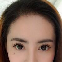 種頭發(fā)有用嗎？種植頭發(fā)恢復過程真實案例——南京明基醫(yī)院