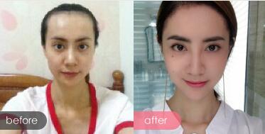 種頭發(fā)有用嗎？種植頭發(fā)恢復(fù)過程真實(shí)案例