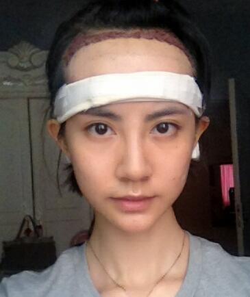 種頭發(fā)有用嗎？種植頭發(fā)恢復(fù)過程真實(shí)案例