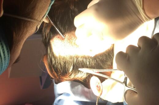 種頭發(fā)有用嗎？種植頭發(fā)恢復(fù)過程真實(shí)案例