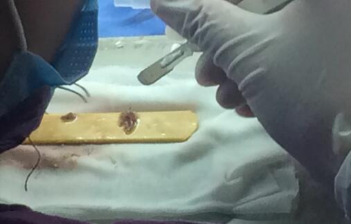 種頭發(fā)有用嗎？種植頭發(fā)恢復(fù)過程真實(shí)案例