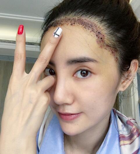 種頭發(fā)有用嗎？種植頭發(fā)恢復(fù)過程真實(shí)案例