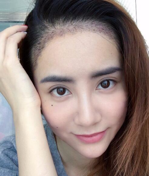 種頭發(fā)有用嗎？種植頭發(fā)恢復(fù)過程真實(shí)案例