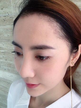 種頭發(fā)有用嗎？種植頭發(fā)恢復(fù)過程真實(shí)案例