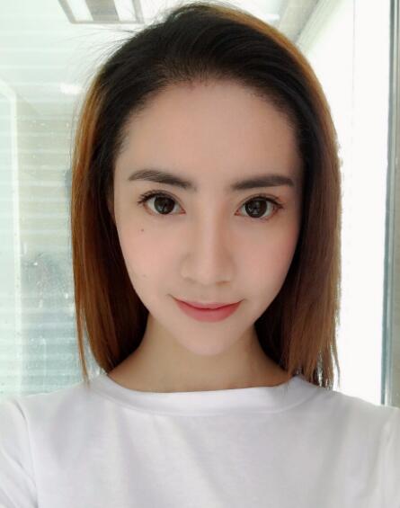 種頭發(fā)有用嗎？種植頭發(fā)恢復(fù)過程真實(shí)案例