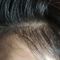 發(fā)際線種植果圖和經歷分享——南京明基整形醫(yī)院