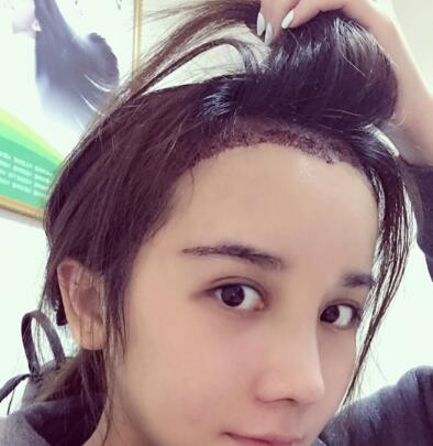 發(fā)際線種植果圖和經(jīng)歷分享——南京明基整形醫(yī)院