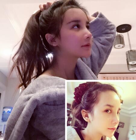 發(fā)際線種植果圖和經(jīng)歷分享