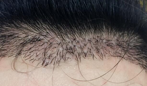 發(fā)際線種植果圖和經(jīng)歷分享