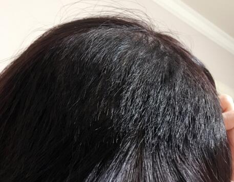 發(fā)際線種植果圖和經(jīng)歷