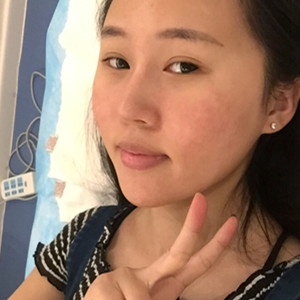 光子嫩膚手術前后過程以及對比照片分享，武漢美都朱紅霞醫(yī)生做的