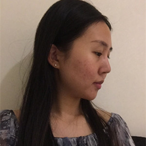 光子嫩膚手術前后過程以及對比照片分享，武漢美都朱紅霞醫(yī)生做的