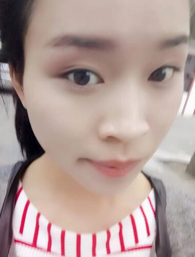 長安醫(yī)院盧丙侖教授V-line瓜子臉手術(shù)前后對比