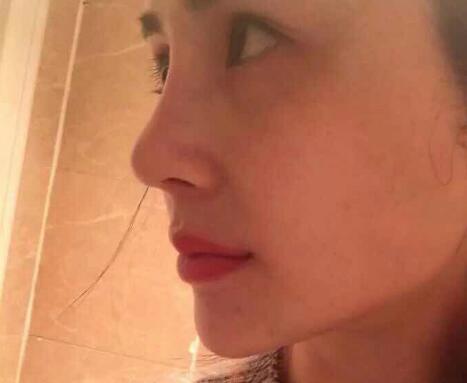 鼻子綜合整形前后對比圖，恢復過程