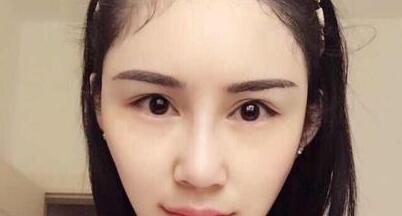 鼻子綜合整形前后對比圖