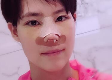 杭州悅可整形醫(yī)院做隆鼻失敗修復(fù)恢復(fù)過(guò)程和對(duì)比圖分享