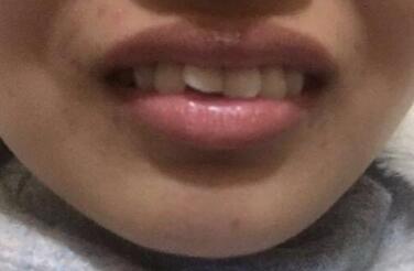 在成都圣貝牙科醫(yī)院做了兩顆純鈦烤瓷牙價格4800元