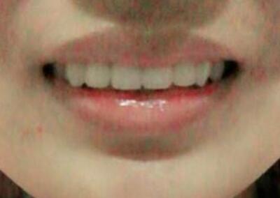 在成都圣貝牙科醫(yī)院做了兩顆純鈦烤瓷牙價格4800元