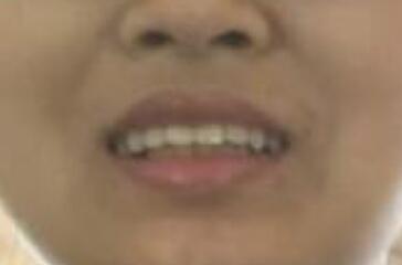 在成都圣貝牙科醫(yī)院做了兩顆純鈦烤瓷牙價格4800元