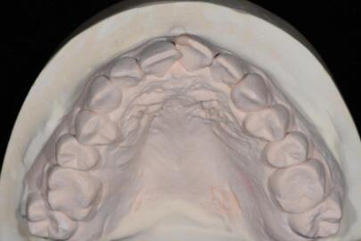 成都圣貝口腔醫(yī)院做了全冠修復(fù)，牙齒排齊美白前后對(duì)比果圖