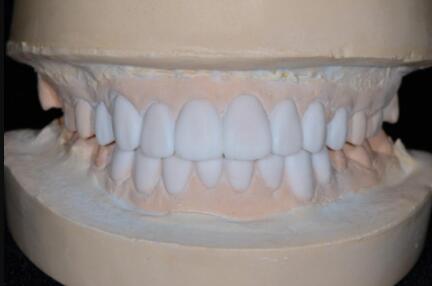 成都圣貝口腔醫(yī)院做了全冠修復(fù)，牙齒排齊美白前后對(duì)比果圖