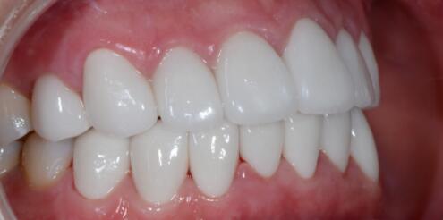 成都圣貝口腔醫(yī)院做了全冠修復(fù)，牙齒排齊美白前后對(duì)比果圖