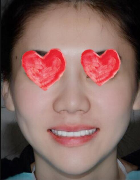 成都圣貝口腔醫(yī)院做了全冠修復(fù)，牙齒排齊美白前后對(duì)比果圖