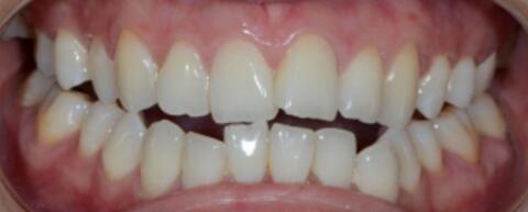 成都圣貝口腔醫(yī)院做了全冠修復(fù)，牙齒排齊美白前后對(duì)比果圖