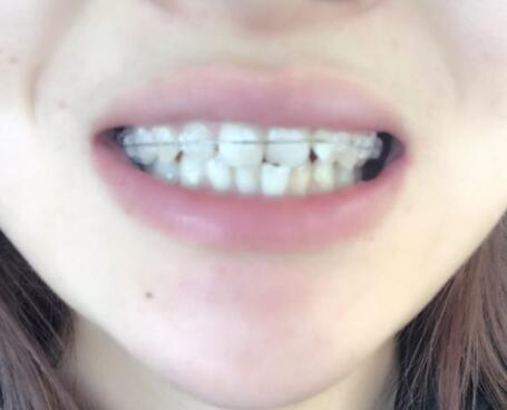 戴隱形牙套矯正牙齒前后對(duì)比圖——成都圣貝牙科醫(yī)院