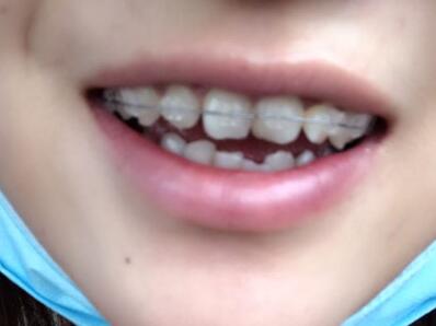 戴隱形牙套矯正牙齒前后對(duì)比圖——成都圣貝牙科醫(yī)院