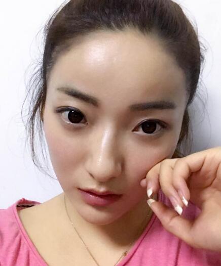 戴隱形牙套矯正牙齒前后對(duì)比圖——成都圣貝牙科醫(yī)院